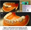 Taiwanese boffins monitor mastication with Bluetooth tooth