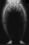 Rickets rise linked to excessive gaming